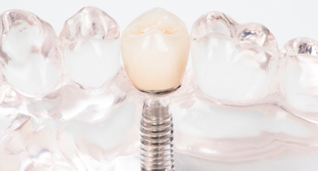 Zahnimplantat in Acryl-Gebissmodell